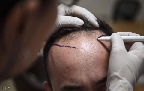 وسط حيرة الأطباء.. وفاة شخص في عملية زراعة شعر